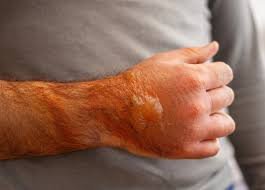 Wound Complications — Seroma Aspiration
